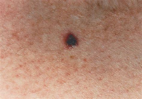 in situ melanoma skin cancer